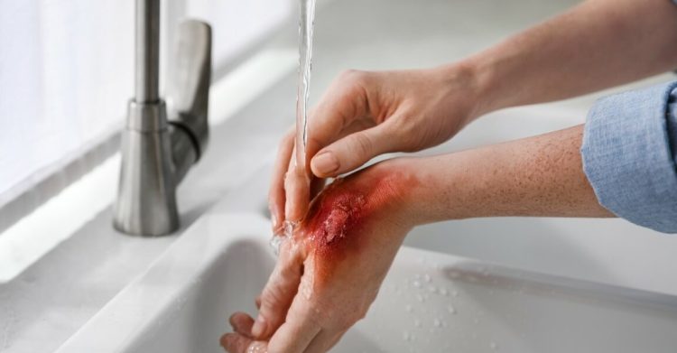 Cedera Jaringan Kulit Atau Seperti Luka Bakar