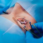 Prosedur Medis Dalam Melakukan Tindakan Laser Mata