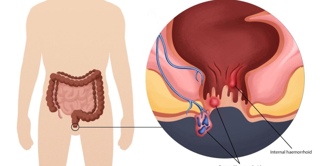Penyakit Bagian Belakang Atau Anus Ambeyen
