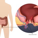 Penyakit Bagian Belakang Atau Anus Ambeyen