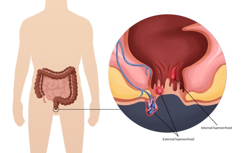 Penyakit Bagian Belakang Atau Anus Ambeyen
